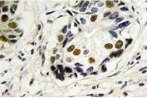 Immunohistochemistry (IHC) analyzes of p53 antibody in paraffin-embedded human breast carcinoma tissue.