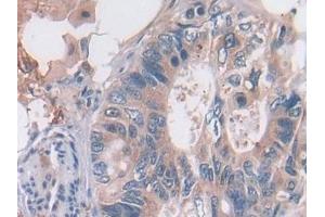 Detection of OAS2 in Human Colorectal cancer Tissue using Polyclonal Antibody to 2',5'-Oligoadenylate Synthetase 2 (OAS2) (OAS2 antibody  (AA 11-346))