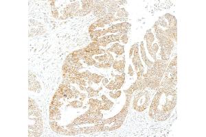 Immunohistochemistry (IHC) image for anti-Metadherin (MTDH) (AA 475-525) antibody (ABIN7795651)