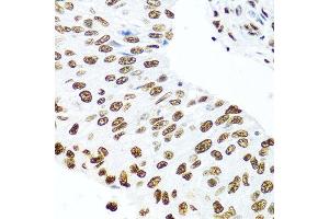 Immunohistochemistry of paraffin-embedded human prostate cancer using SSB antibody at dilution of 1:100 (40x lens). (SSB antibody)