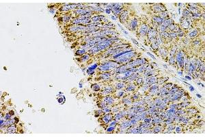 Immunohistochemistry of paraffin-embedded Human colon carcinoma using ALDH1A1 Polyclonal Antibody at dilution of 1:100 (40x lens). (ALDH1A1 antibody)