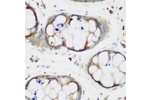 Immunohistochemistry of paraffin-embedded human gastric using MTDH antibody (ABIN5975399) at dilution of 1/200 (40x lens). (MTDH antibody)