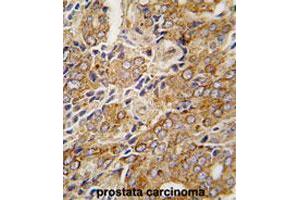 Formalin-fixed and paraffin-embedded human prostate carcinomareacted with TRPM8 polyclonal antibody , which was peroxidase-conjugated to the secondary antibody, followed by AEC staining. (TRPM8 antibody  (AA 933-963))