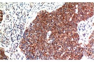 Immunohistochemistry of paraffin-embedded Human breast carcinoma tissue using BECN1 Monoclonal Antibody at dilution of 1:200. (Beclin 1 antibody)