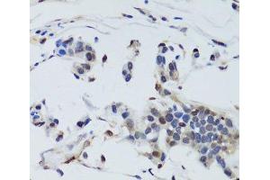 Immunohistochemistry of paraffin-embedded Human gastric cancer using DNMT1 Polyclonal Antibody at dilution of 1:200 (40x lens). (DNMT1 antibody)