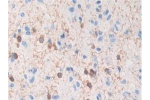 Detection of TPPP in Human Glioma Tissue using Polyclonal Antibody to Tubulin Polymerization Promoting Protein (TPPP) (Tppp antibody  (AA 8-210))