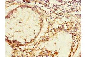 Immunohistochemistry of paraffin-embedded human colon cancer using ABIN7171814 at dilution of 1:100 (TEX43 antibody  (AA 1-134))