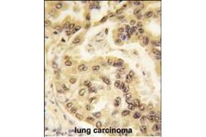 Formalin-fixed and paraffin-embedded human lung carcinoma tissue reacted with p53 Antibody  h , which was peroxidase-conjugated to the secondary antibody, followed by DAB staining. (p53 antibody  (AA 293-322))