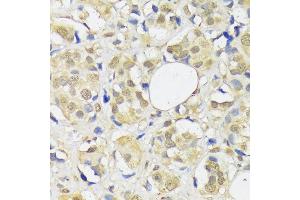 Immunohistochemistry of paraffin-embedded human breast cancer using  antibody (ABIN1678593, ABIN3018971, ABIN3018972 and ABIN6220651) at dilution of 1:100 (40x lens). (ADRM1 antibody  (AA 108-407))