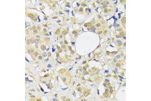 Immunohistochemistry of paraffin-embedded human breast cancer using  antibody (ABIN1678593, ABIN3018971, ABIN3018972 and ABIN6220651) at dilution of 1:100 (40x lens).