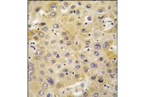 Formalin-fixed and paraffin-embedded human hepatocarcinoma tissue reacted with PPBP antibody (C-term), which was peroxidase-conjugated to the secondary antibody, followed by DAB staining. (CXCL7 antibody  (C-Term))