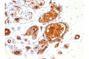 Formalin-fixed, paraffin-embedded human Breast Carcinoma stained with MUC1 Mouse Monoclonal Antibody (115D8). (MUC1 antibody)