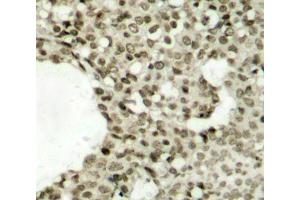 Immunohistochemistry of paraffin-embedded human breast carcinoma tissue, using Phospho-STAT1-S727 antibody (ABIN2988310).