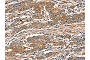 The image on the left is immunohistochemistry of paraffin-embedded Human gastic cancer tissue using ABIN7129096(CUEDC2 Antibody) at dilution 1/30, on the right is treated with fusion protein.