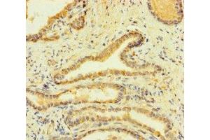 Immunohistochemistry of paraffin-embedded human prostate cancer using ABIN7155180 at dilution of 1:100 (Fc epsilon RI/FCER1A antibody  (AA 26-205))
