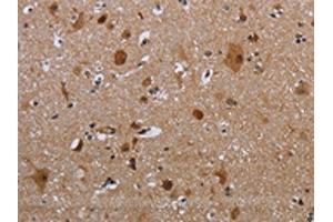 The image on the left is immunohistochemistry of paraffin-embedded Human brain tissue using ABIN7191347(MAGEB18 Antibody) at dilution 1/20, on the right is treated with synthetic peptide. (MAGEB18 antibody)
