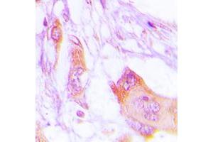 Immunohistochemical analysis of MARK staining in human lung cancer formalin fixed paraffin embedded tissue section. (MARK1 antibody  (Center))