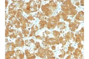 IHC testing of FFPE human thyroid carcinoma with TSHR antibody (clone TSHRA/1402). (TSHR, A Chain antibody)