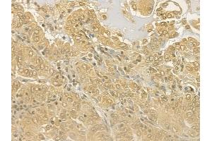 ABIN6263086 and ABIN6277126 at 1/100 staining human lung adenocarcinoma by IHC-P.