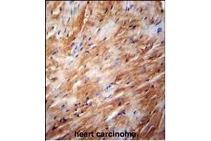 TFB2M Antibody (C-term) (ABIN654104 and ABIN2843988) immunohistochemistry analysis in formalin fixed and paraffin embedded human heart carcinoma followed by peroxidase conjugation of the secondary antibody and DAB staining. (TFB2M antibody  (C-Term))