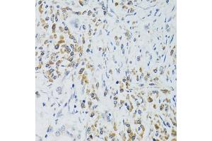 Immunohistochemistry of paraffin-embedded human colon carcinoma using SRP19 antibody (ABIN2560139) at dilution of 1:100 (40x lens). (SRP19 antibody)