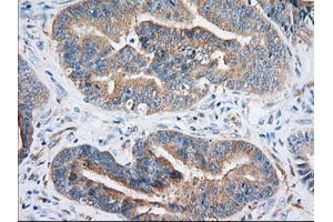 Immunohistochemistry (IHC) image for anti-Insulin-Like Growth Factor 2 mRNA Binding Protein 2 (IGF2BP2) antibody (ABIN1498821) (IGF2BP2 antibody)