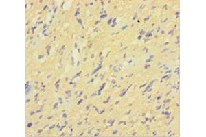 Immunohistochemistry of paraffin-embedded human glioma using ABIN7156965 at dilution of 1:100 (ISX antibody  (AA 1-245))