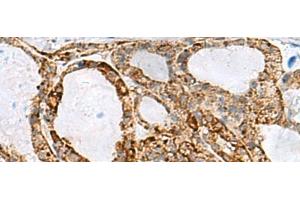 Immunohistochemistry of paraffin-embedded Human thyroid cancer tissue using MED31 Polyclonal Antibody at dilution of 1:100(x200) (MED31 antibody)