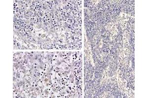 Immunohistochemistry of HumanIL1beta_antibod Tissue: medullary lymph node Fixation: formalin fixed paraffin embedded Antigen retrieval: user optimized Primary antibody: Human IL1beta antibody Secondary antibody: Peroxidase goat anti-rabbit at 1:10,000 for 45 min at RT Localization: cytoplasm Staining: Close up of medullary lymph node: positive staining in the cytoplasm of circulating macrophages. (IL-1 beta antibody)