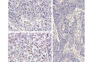 Immunohistochemistry of HumanIL1beta_antibod Tissue: medullary lymph node Fixation: formalin fixed paraffin embedded Antigen retrieval: user optimized Primary antibody: Human IL1beta antibody Secondary antibody: Peroxidase goat anti-rabbit at 1:10,000 for 45 min at RT Localization: cytoplasm Staining: Close up of medullary lymph node: positive staining in the cytoplasm of circulating macrophages. (IL-1 beta antibody  (Cleavage Site, N-Term))