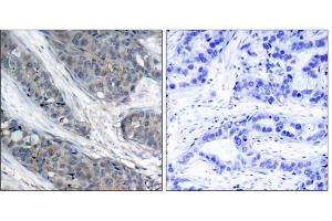 Immunohistochemical analysis of paraffin-embedded human breast carcinoma tissue, using IRS-1 (phospho-Ser307) antibody (E011235). (IRS1 antibody  (pSer307))