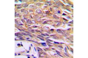 Immunohistochemical analysis of p23 staining in human prostate cancer formalin fixed paraffin embedded tissue section. (CDK5R1 antibody  (Center))