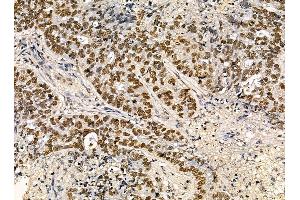 ABIN7095426 and ABIN7099483 at 1/100 staining human liver cancer and adjacent non-tumor tissue by IHC-P.