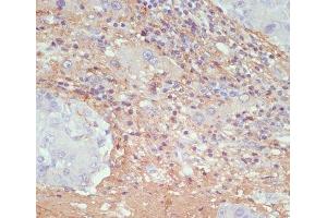 Immunohistochemistry of paraffin-embedded Human liver cancer using COL1A1 Polyclonal Antibody at dilution of 1:200 (40x lens). (COL1A1 antibody)