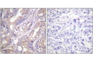 Immunohistochemistry analysis of paraffin-embedded human breast carcinoma tissue, using A-RAF (Ab-301/302) Antibody.