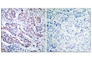 Immunohistochemical analysis of paraffin-embedded human breast carcinoma tissue, using TYK2 (Ab-1054) antibody (E021118). (TYK2 antibody)