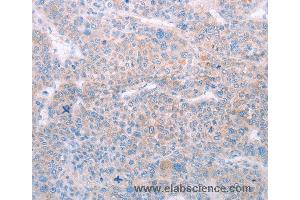 Immunohistochemistry of Human lung cancer using SPATA6 Polyclonal Antibody at dilution of 1:50