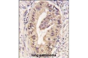 Formalin-fixed and paraffin-embedded human lung carcinoma tissue reacted with ATG16L1 Monoclonal Antibody (ABIN6243484 and ABIN6577053) , which was peroxidase-conjugated to the secondary antibody, followed by DAB staining. (ATG16L1 antibody)