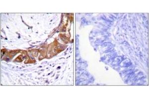 Immunohistochemistry analysis of paraffin-embedded human colon carcinoma, using IRAK1 (Phospho-Thr100) Antibody. (IRAK1 antibody  (pThr100))