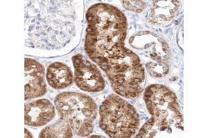 ABIN6267641 at 1/200 staining human kidney carcinoma tissue sections by IHC-P. (eIF4EBP1 antibody  (pThr45))