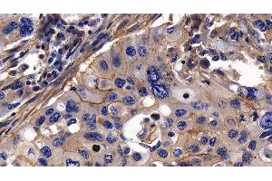 Detection of ITGaV in Human Lung cancer Tissue using Polyclonal Antibody to Integrin Alpha V (ITGaV) (CD51 antibody  (AA 560-744))