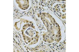 Immunohistochemistry of paraffin-embedded human gastric cancer using LGALS3 Antibody (ABIN5970683) at dilution of 1/200 (40x lens). (Galectin 3 antibody)