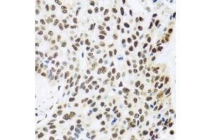 Immunohistochemistry of paraffin-embedded human lung cancer using FUBP1 antibody (ABIN6130392, ABIN6140802, ABIN6140804 and ABIN6221231) at dilution of 1:100 (40x lens). (FUBP1 antibody  (AA 302-644))