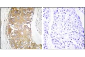 Immunohistochemistry analysis of paraffin-embedded human breast carcinoma tissue, using FRK Antibody. (FRK antibody  (AA 71-120))