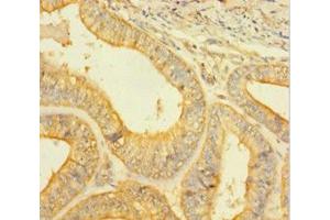 Immunohistochemistry of paraffin-embedded human endometrial cancer using ABIN7146926 at dilution of 1:100 (Caspase 1 antibody  (AA 120-269))