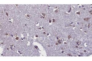 ABIN6276443 at 1/100 staining Human brain cancer tissue by IHC-P. (TLR7 antibody  (Internal Region))