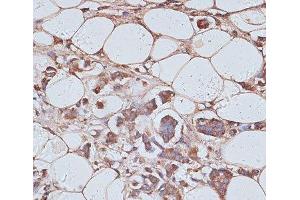 Immunohistochemistry of paraffin-embedded Human breast cancer using TAX1BP1 Polyclonal Antibody at dilution of 1:100 (40x lens). (TAX1BP1 antibody)