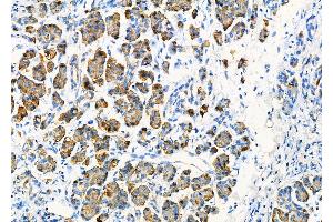 ABIN6264112 and ABIN6277799 at 1/100 staining Human pancreatic cancer and adjacent nomal tissues by IHC-P. (PDIA2 antibody  (C-Term))