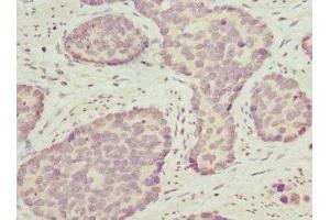 Immunohistochemistry of paraffin-embedded human gastric cancer using ABIN7162208 at dilution of 1:100