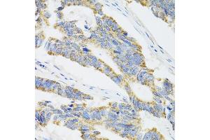 Immunohistochemistry of paraffin-embedded human colon carcinoma using CYP1A1 antibody. (CYP1A1 antibody)
